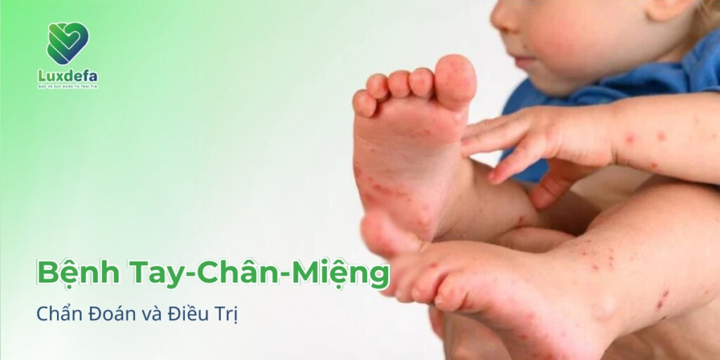 Chẩn Đoán và Điều Trị Bệnh Tay-Chân-Miệng