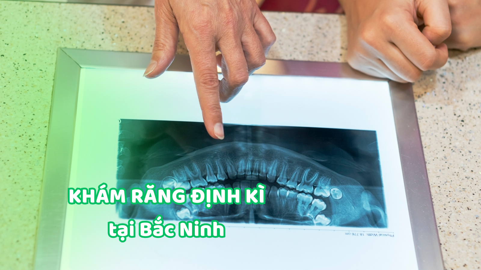 khám răng định kỳ tại Bắc Ninh